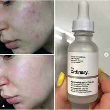 The Ordinary Niacinamide 10% + Zinc 1% Serum – 30ml
